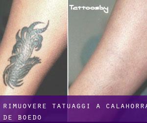 Rimuovere Tatuaggi a Calahorra de Boedo