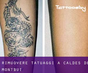 Rimuovere Tatuaggi a Caldes de Montbui