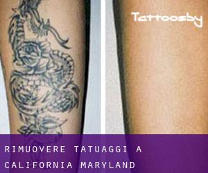 Rimuovere Tatuaggi a California (Maryland)