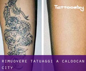 Rimuovere Tatuaggi a Caloocan City