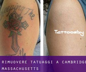 Rimuovere Tatuaggi a Cambridge (Massachusetts)
