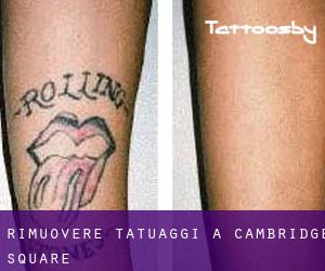 Rimuovere Tatuaggi a Cambridge Square