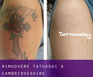 Rimuovere Tatuaggi a Cambridgeshire