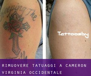 Rimuovere Tatuaggi a Cameron (Virginia Occidentale)