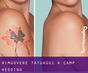 Rimuovere Tatuaggi a Camp Hedding