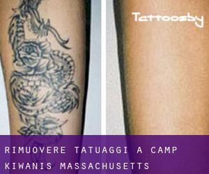 Rimuovere Tatuaggi a Camp Kiwanis (Massachusetts)