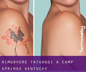 Rimuovere Tatuaggi a Camp Springs (Kentucky)