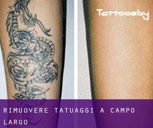 Rimuovere Tatuaggi a Campo Largo