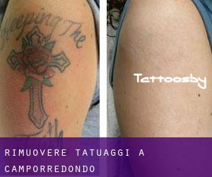 Rimuovere Tatuaggi a Camporredondo