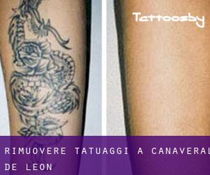 Rimuovere Tatuaggi a Cañaveral de León
