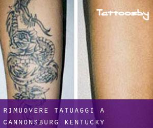 Rimuovere Tatuaggi a Cannonsburg (Kentucky)