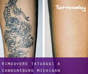 Rimuovere Tatuaggi a Cannonsburg (Michigan)