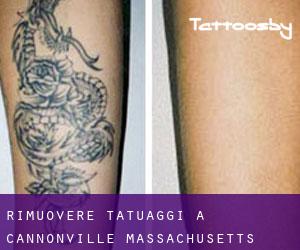 Rimuovere Tatuaggi a Cannonville (Massachusetts)