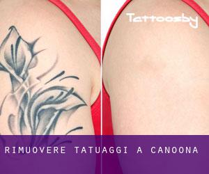 Rimuovere Tatuaggi a Canoona
