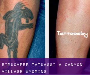Rimuovere Tatuaggi a Canyon Village (Wyoming)