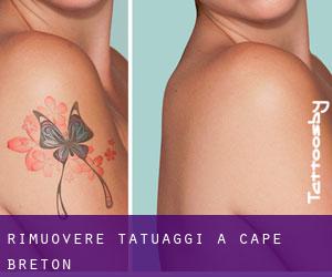 Rimuovere Tatuaggi a Cape Breton