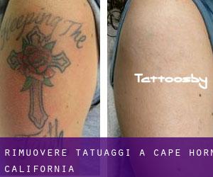 Rimuovere Tatuaggi a Cape Horn (California)