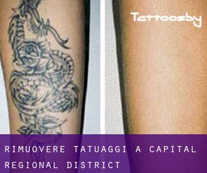Rimuovere Tatuaggi a Capital Regional District