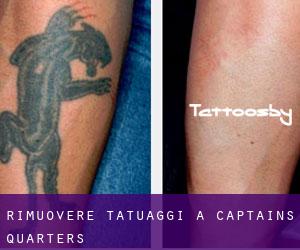 Rimuovere Tatuaggi a Captains Quarters
