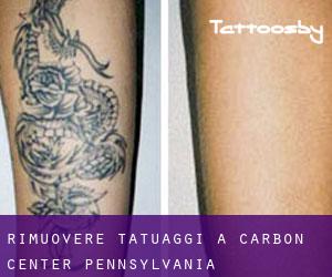 Rimuovere Tatuaggi a Carbon Center (Pennsylvania)