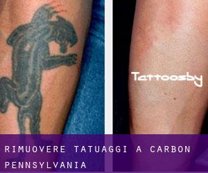 Rimuovere Tatuaggi a Carbon (Pennsylvania)