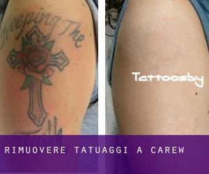 Rimuovere Tatuaggi a Carew