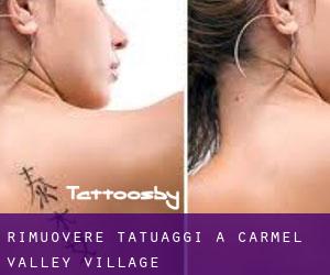 Rimuovere Tatuaggi a Carmel Valley Village
