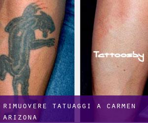 Rimuovere Tatuaggi a Carmen (Arizona)