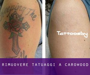 Rimuovere Tatuaggi a Carowood