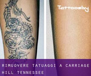 Rimuovere Tatuaggi a Carriage Hill (Tennessee)