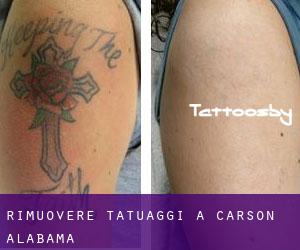 Rimuovere Tatuaggi a Carson (Alabama)