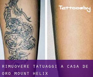 Rimuovere Tatuaggi a Casa de Oro-Mount Helix