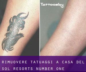 Rimuovere Tatuaggi a Casa del Sol Resorts Number One