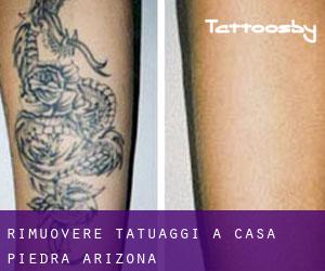 Rimuovere Tatuaggi a Casa Piedra (Arizona)