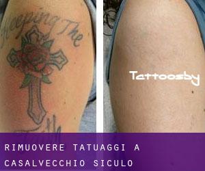 Rimuovere Tatuaggi a Casalvecchio Siculo
