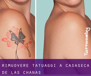 Rimuovere Tatuaggi a Casaseca de las Chanas