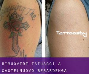 Rimuovere Tatuaggi a Castelnuovo Berardenga