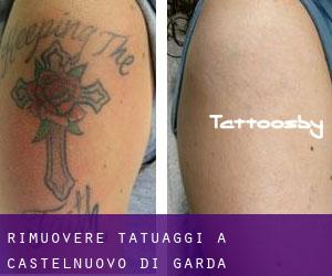 Rimuovere Tatuaggi a Castelnuovo di Garda