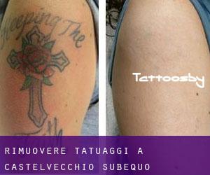 Rimuovere Tatuaggi a Castelvecchio Subequo
