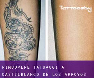 Rimuovere Tatuaggi a Castilblanco de los Arroyos