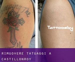 Rimuovere Tatuaggi a Castillonroy
