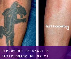 Rimuovere Tatuaggi a Castrignano de' Greci