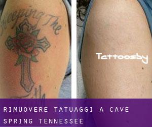 Rimuovere Tatuaggi a Cave Spring (Tennessee)
