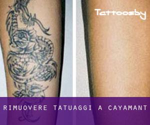 Rimuovere Tatuaggi a Cayamant