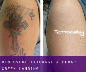 Rimuovere Tatuaggi a Cedar Creek Landing