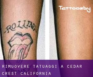 Rimuovere Tatuaggi a Cedar Crest (California)