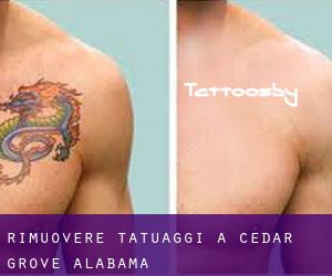Rimuovere Tatuaggi a Cedar Grove (Alabama)