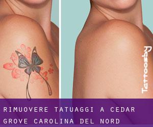 Rimuovere Tatuaggi a Cedar Grove (Carolina del Nord)