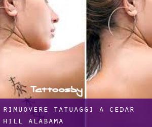 Rimuovere Tatuaggi a Cedar Hill (Alabama)