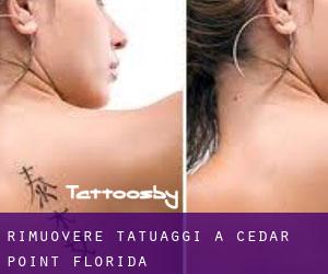 Rimuovere Tatuaggi a Cedar Point (Florida)